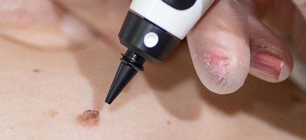 After Skin Tag Removal Dorset