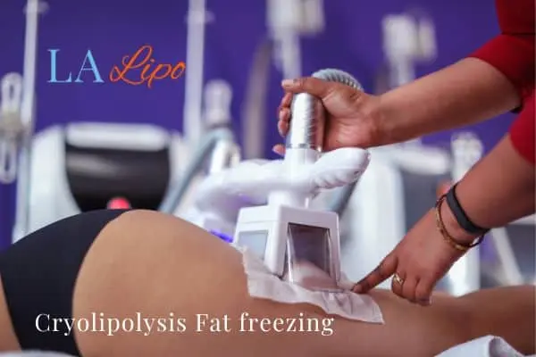 women getting fat freezing Dorset