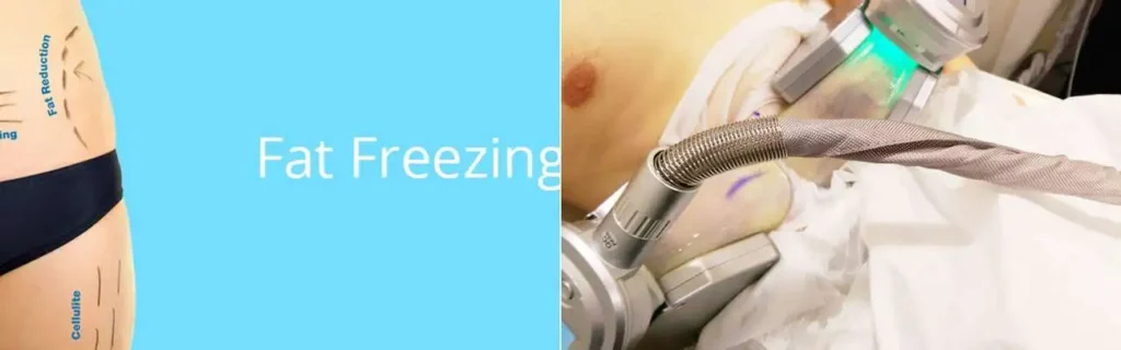 Fat freezing Dorset on multiple areas of the body