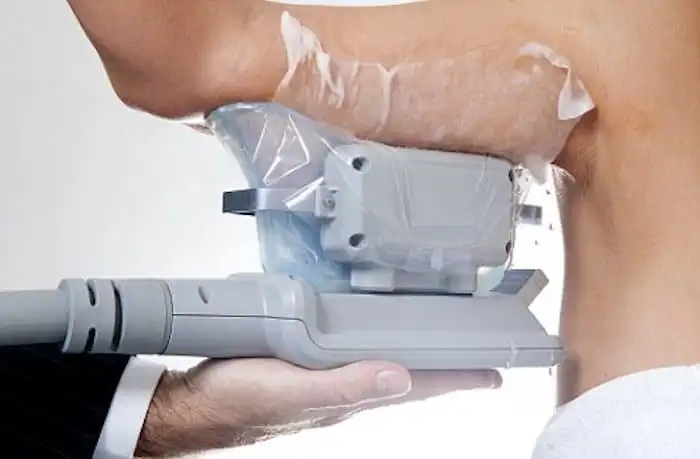 Picture of fat freezing Dorset on the upper arms.