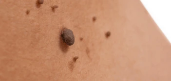 image of a skin tag Dorset