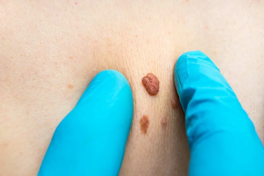 Consultant examining a skin tag Dorset