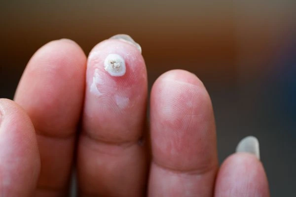wart on person finger - cryotherapy to treat from LA LIPO Dorset