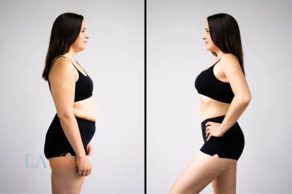 Picture of womans before and after using LA-EMS body sculpting to improve her core strength Dorset