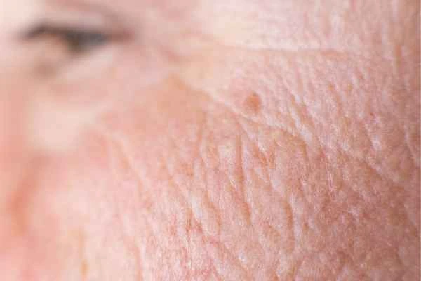 close up picture of a woman's face showing an age spot Dorset