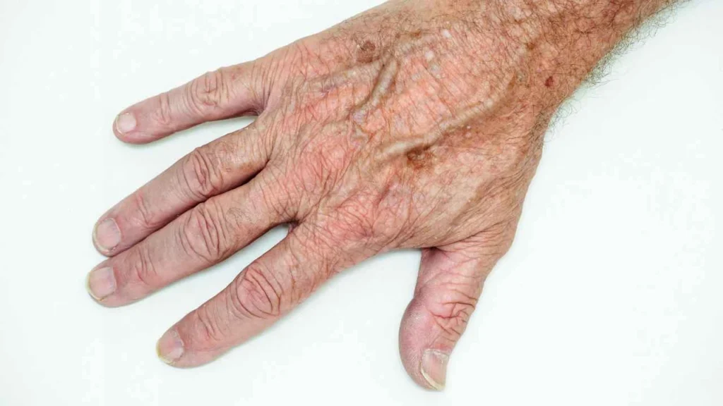 Male hand showing age spot Dorset